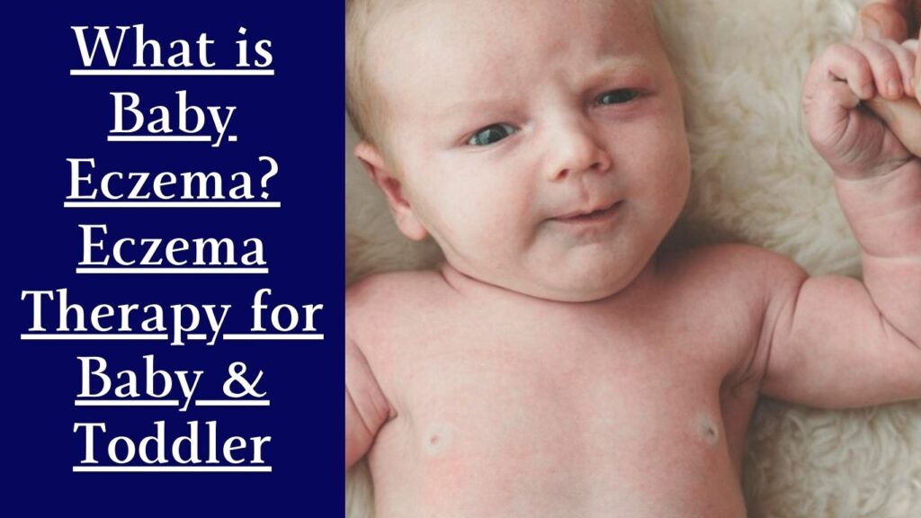 Baby Eczema 