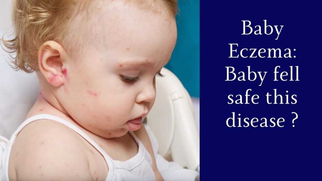 Baby Eczema
